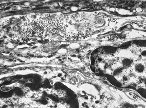 F,41y. | synovial metaplasia - capsule of implantate